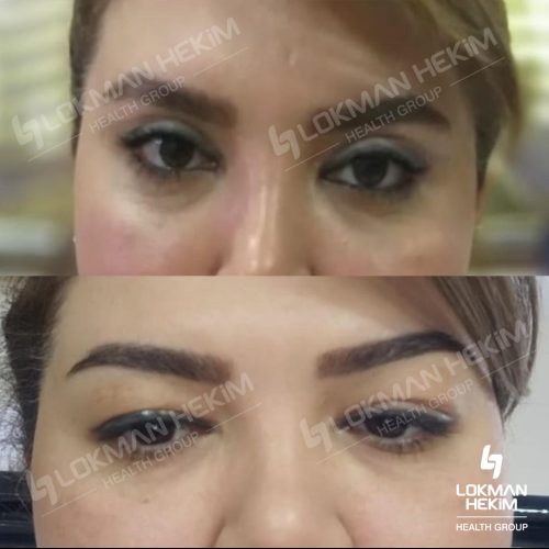 Blepharoplasty Before / After photo
